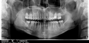 「ハリウッドスマイル8症例めの矯正歯科治療前のレントゲン」